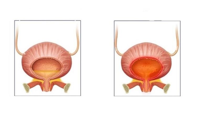 Normal ve idrar yolunun sistitli hastalar