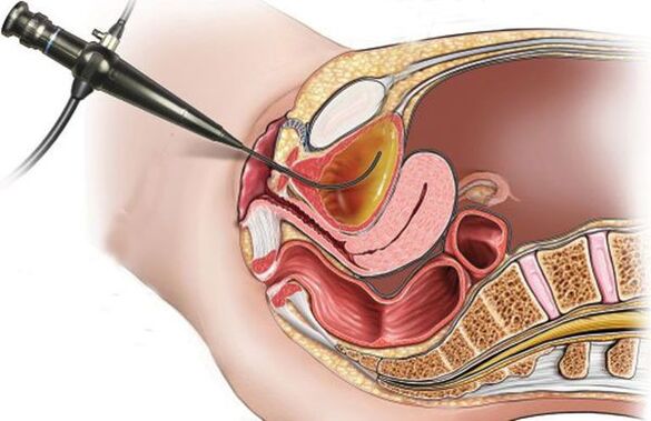 sistit için sistoskopi